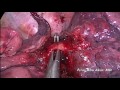 Uniportal vats right lower lobectomy with absence of arterial branch to segment 6