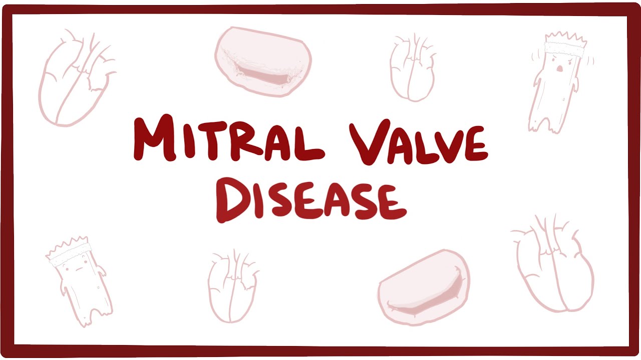 Mitral valve disease (regurgitation, stenosis) - causes, symptoms & pathology - Mitral valve disease (regurgitation, stenosis) - causes, symptoms & pathology