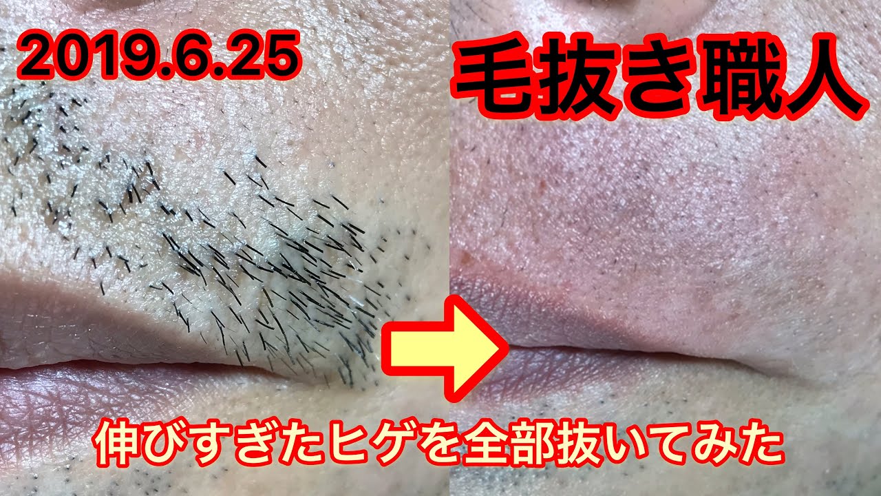 ずっと見ていられる密林のヒゲ抜き 2019 6 25 鼻下ヒゲ抜き Plucking Facial Hair Youtube