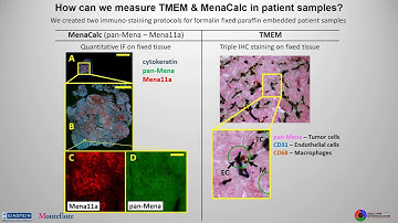 Development and analytical validation of prognostic biomarkers for metastasis