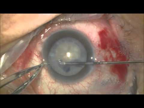 Spiral capsulorhexis,intumescent cataract.Grigor Kamushadze MD გრიგოლ ქამუშაძე