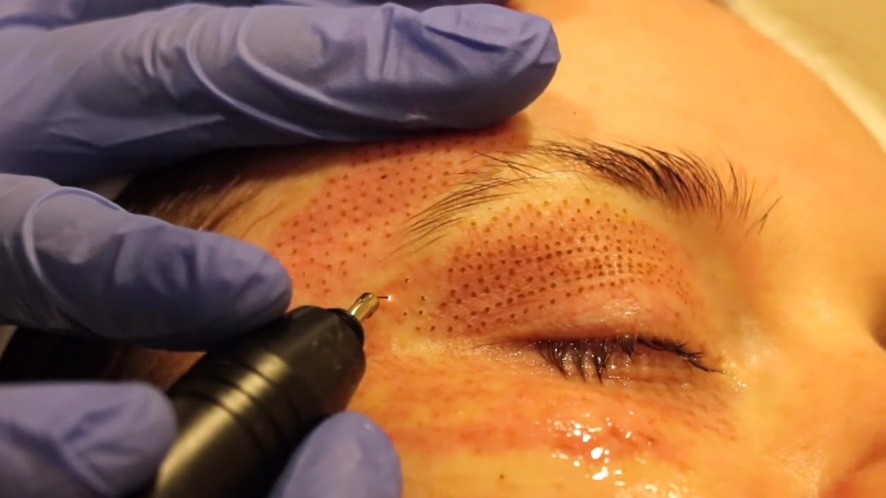 Eyebrow and Upper Eyelid Plasma Pen YouTube
