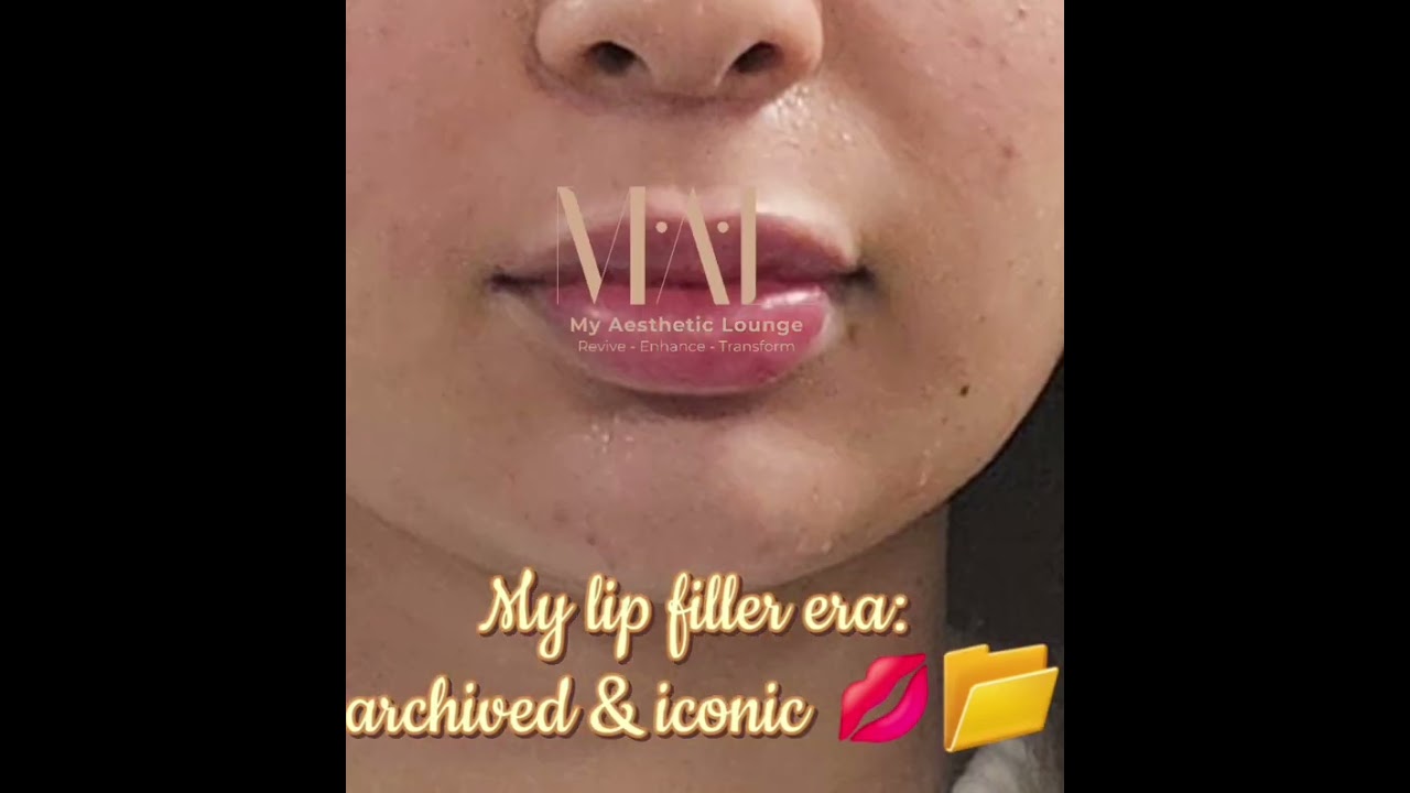 Pout perfected 💋 Subtle lip filler for that natural, fuller look! 