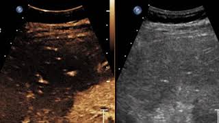 solid renal mass-OHSU Contrast Enhanced Ultrasound (CEUS)