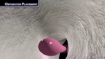 GuttaCore® Obturator Placement | Dentsply Sirona