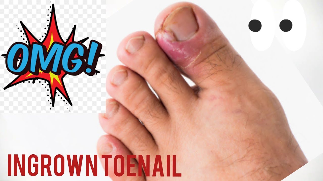 Removal ingrown toenail. 