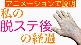 【5分で説明】私の脱ステロイドと脱保湿後の経過について