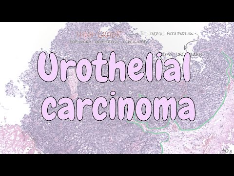 Urothelial carcinoma - urinary system pathology