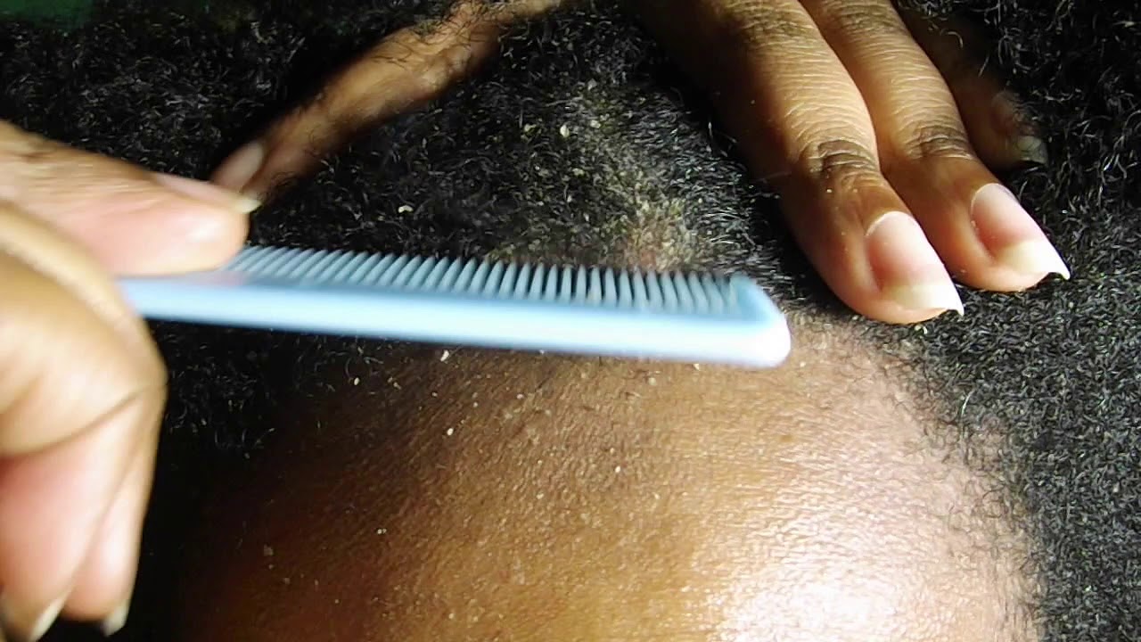 FLAKEY SCALP SCRATCHING PSORIASIS SCRATCHING YouTube