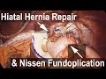 Nissen Fundoplication with Hiatal Hernia Repair - Animation & Actual Surgical Footage