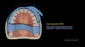 Veneer preparation GUIDE-Facial preparation