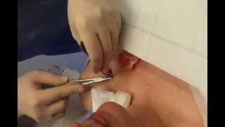 Removal of chemo port after Breast Cancer Treatment