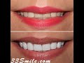 Cosmetic dentistry prepless dental veneers before and after