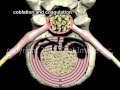Treatment of Bulging Disc - Coblation - decompression - Narration &amp; Animation by Cal Shipley, M.D.