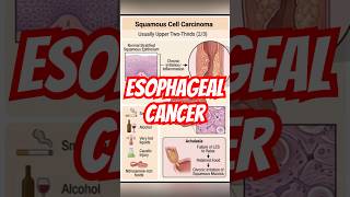 Esophageal Cancer Types Explained ⚠️ | SCC vs Adenocarcinoma | Full Lecture Link Below