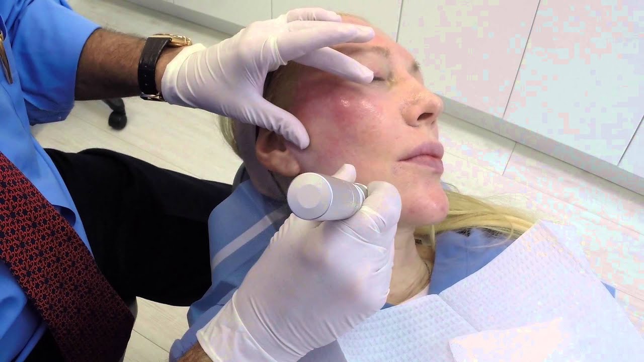 Micro Needling with PRP (Platelet Rich Plasma) YouTube