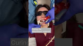 Orthodontist getting attachments #orthodontist