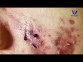 HHV Clinic | Đỗ Thu Hiền | Hiền Vân Spa- These moments in acne extraction 2