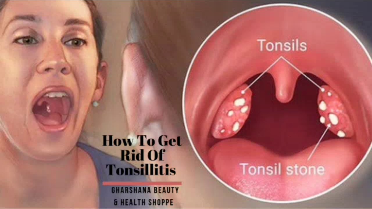 Sign Of Tonsillitis Causes Symptoms And Treatment How To Get Rid Of