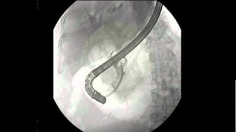 Dr. Sedici Case Study -- Cholangioscopy using SpyGlass System with Holmium Laser Lithotripsy
