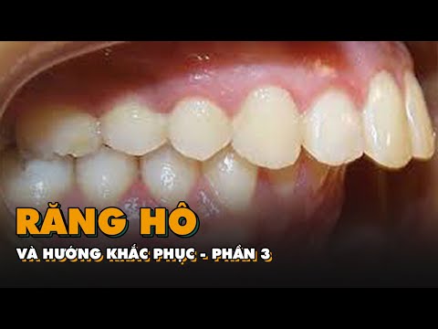 hướng dẫn vệ sinh răng miệng khi mang mắc cài tại Kemtrinam.vn