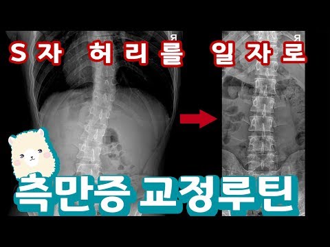 [현직물리치료사] 실제 척추 측만증 교정 루틴 | 정파카