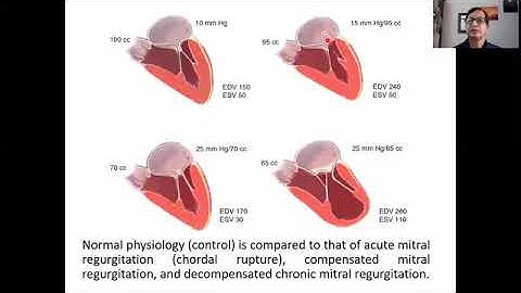 IPDI Virtual Classroom (Lecture-1, Vulvular Heart Disease, Part-1)