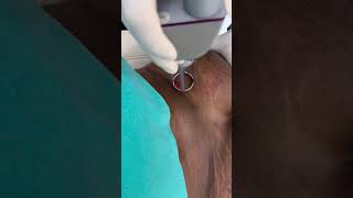 ✅Treatment of Stretch Marks by CO2 laser | shorts shortsfeed stretchmarksremoval
