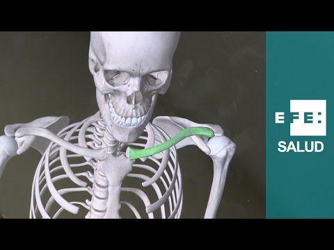 Video: Cómo aliviar el dolor de una fractura de clavícula: 11 pasos