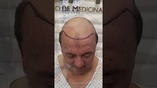 TRNSPLANTE CAPILAR - MAIS PRESENÇA VISUAL
