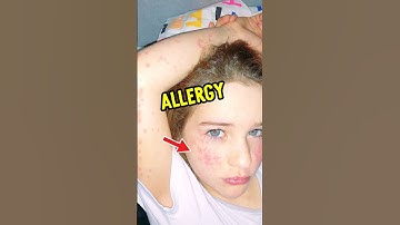 Testing Weird Allergies My Family Has (1%) #norrisnuts