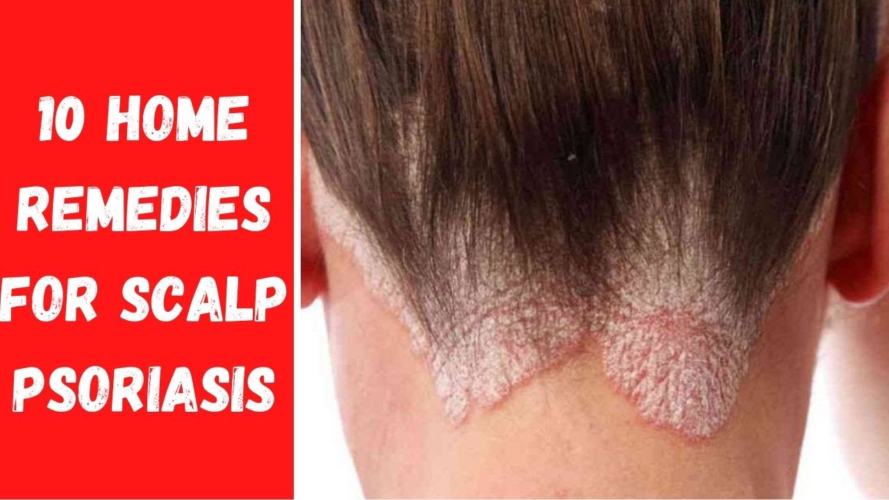 ⚠⚠👉 HOW TO GET RID OF PSORIASIS ON THE SCALP NATURALLY? | 10 HOME