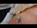 Laser tattoo removal with qswitched ndyag