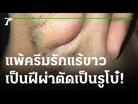 สาวโพสต์ แพ้ครีมรักแร้ขาว เป็นฝี ผ่าตัดเป็นรูโบ๋ | 12-05-65 | ข่าวเย็นไทยรัฐ