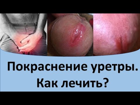 Как расширить уретру в домашних условиях