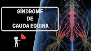 SÍNDROME DE CAUDA EQUINA