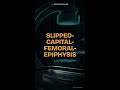 SCFE Explained: Slipped Capital Femoral Epiphysis Masterclass