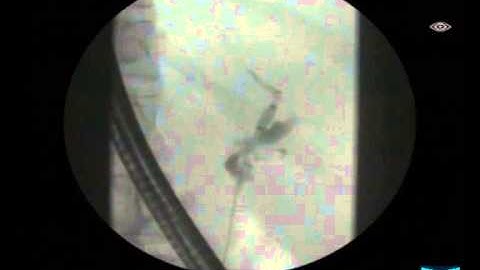 Primary Sclerosing Cholangitis with Dilation of a Dominant Stenosis