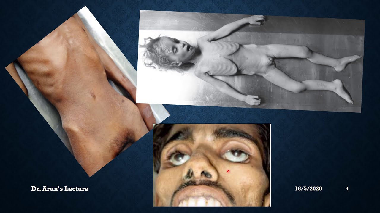 Autopsy Medicolegal Importance Of Starvation YouTube Autopsy Medicolegal Importance Of Starvation YouTube