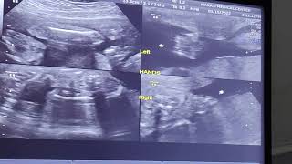 Alphonse's 3D Ultrasound Jan 2022