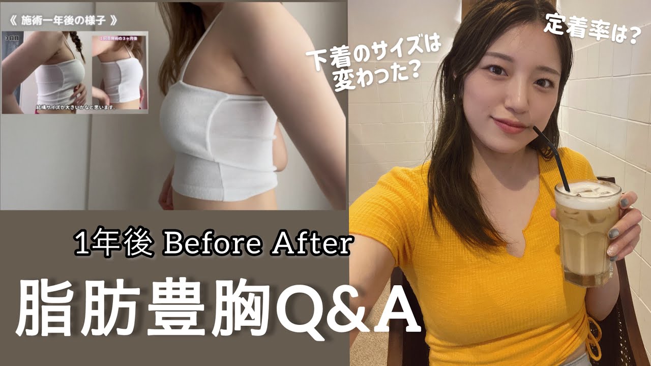 【脂肪豊胸】Q&Aと１年経ったのでビフォアフ見せます！（比較写真あり）