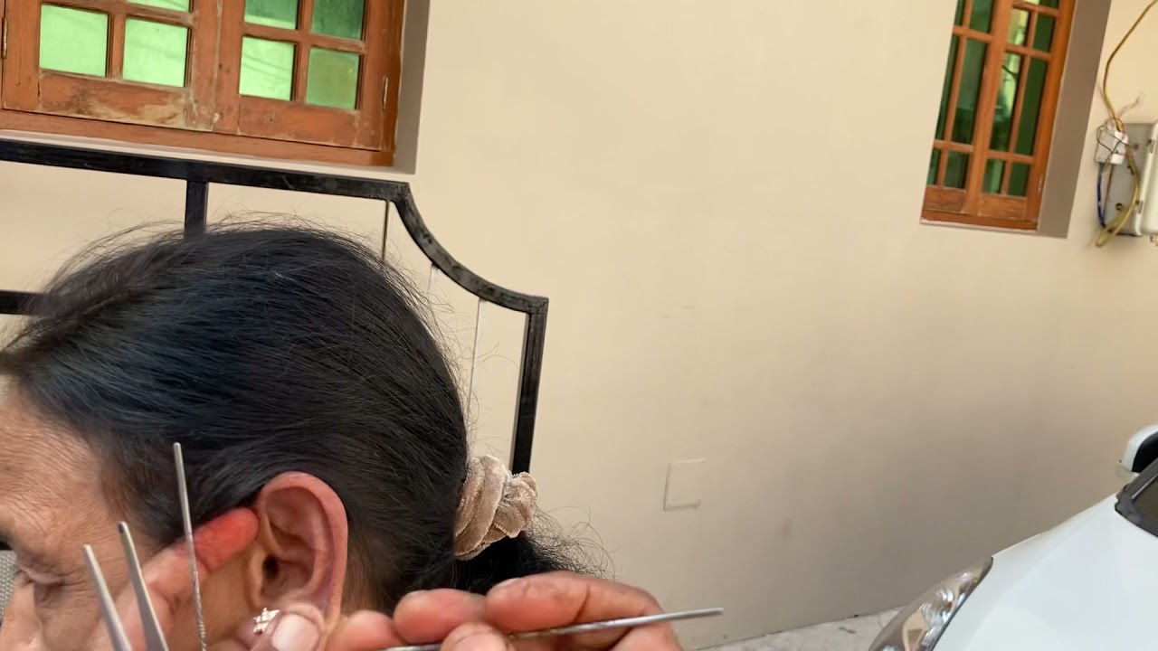 BIGGEST EAR WAX PUECE REMOVAL. Do not try this at home... Professional