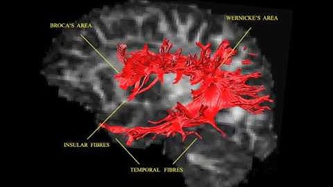 MRI-based diffusion tensor imaging (DTI) and tractography
