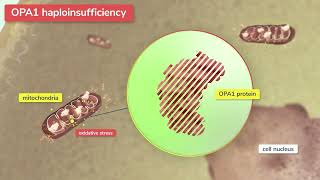 Stoke Theutics - Autosomal Dominant Optic Atrophy Adoa