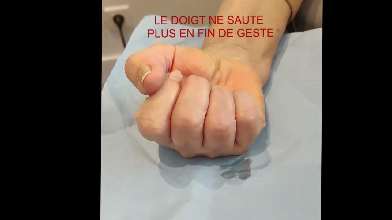 Pourquoi Leve T On Le Petit Doigt En Buvant Doigt à ressaut - Libération percutanée échoguidée - YouTube