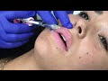 Lip injections treatment and before and after at aesthetica medical spa in utah