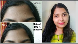 How to Remover tiny Bumps, Pimples on forehead naturally | 100% works home remedies | Sankita Patil