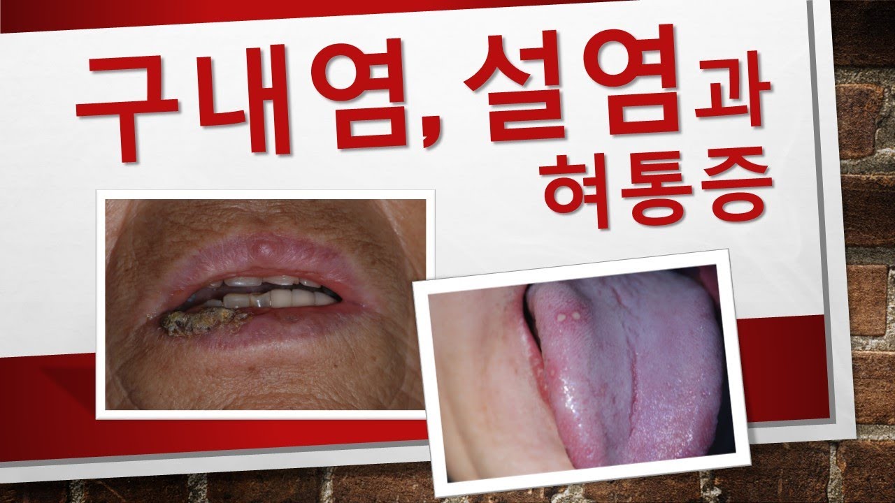 입안에 염증, 혀염증. 설염 구내염 구순염의 종류. 혀통증을 일으키는 혀염증 - YouTube