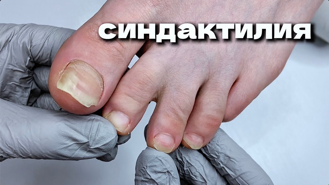 СИНДАКТИЛИЯ, деформация ногтя и обработка онихолизиса