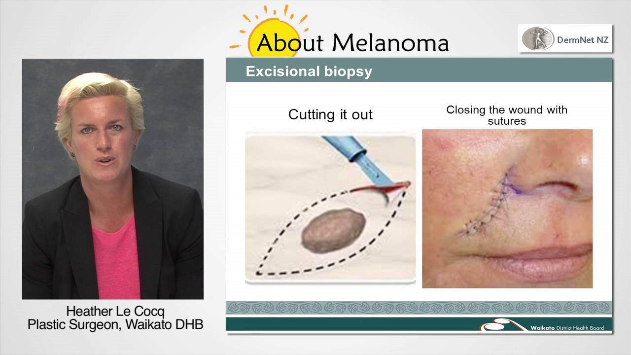 How Is Melanoma Removed YouTube how-is-melanoma-removed-youtube